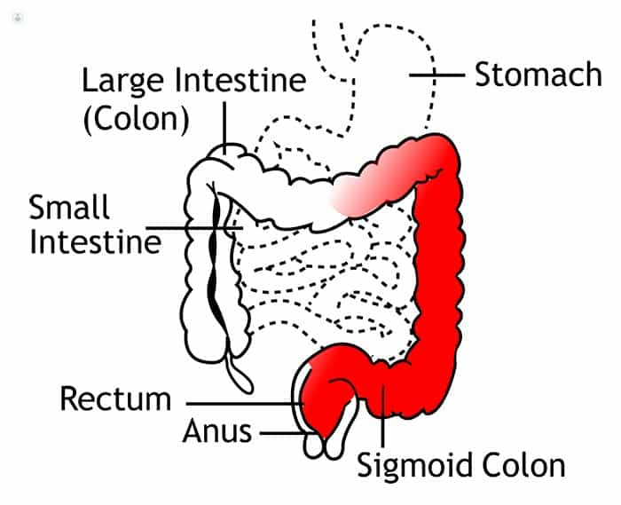 Ulcerative Colitis – Symptoms, Diagnosis, and Treatment – Costamedic