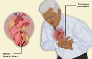 Read more about the article Unstable Angina