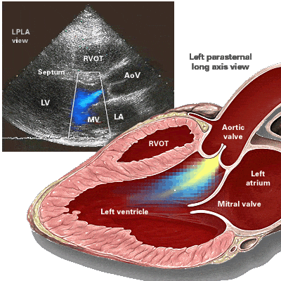 aortic valve regurgitation