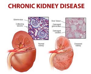 Read more about the article Chronic Kidney Disease – Symptoms, Causes, and Treatment