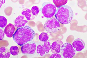 Read more about the article Chronic Myeloid Leukemia (CML) – Symptoms, Diagnosis, and Treatment