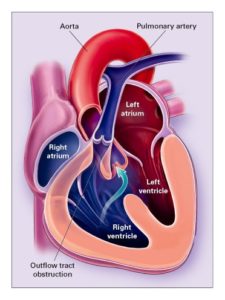 Read more about the article Congenital Heart Disease