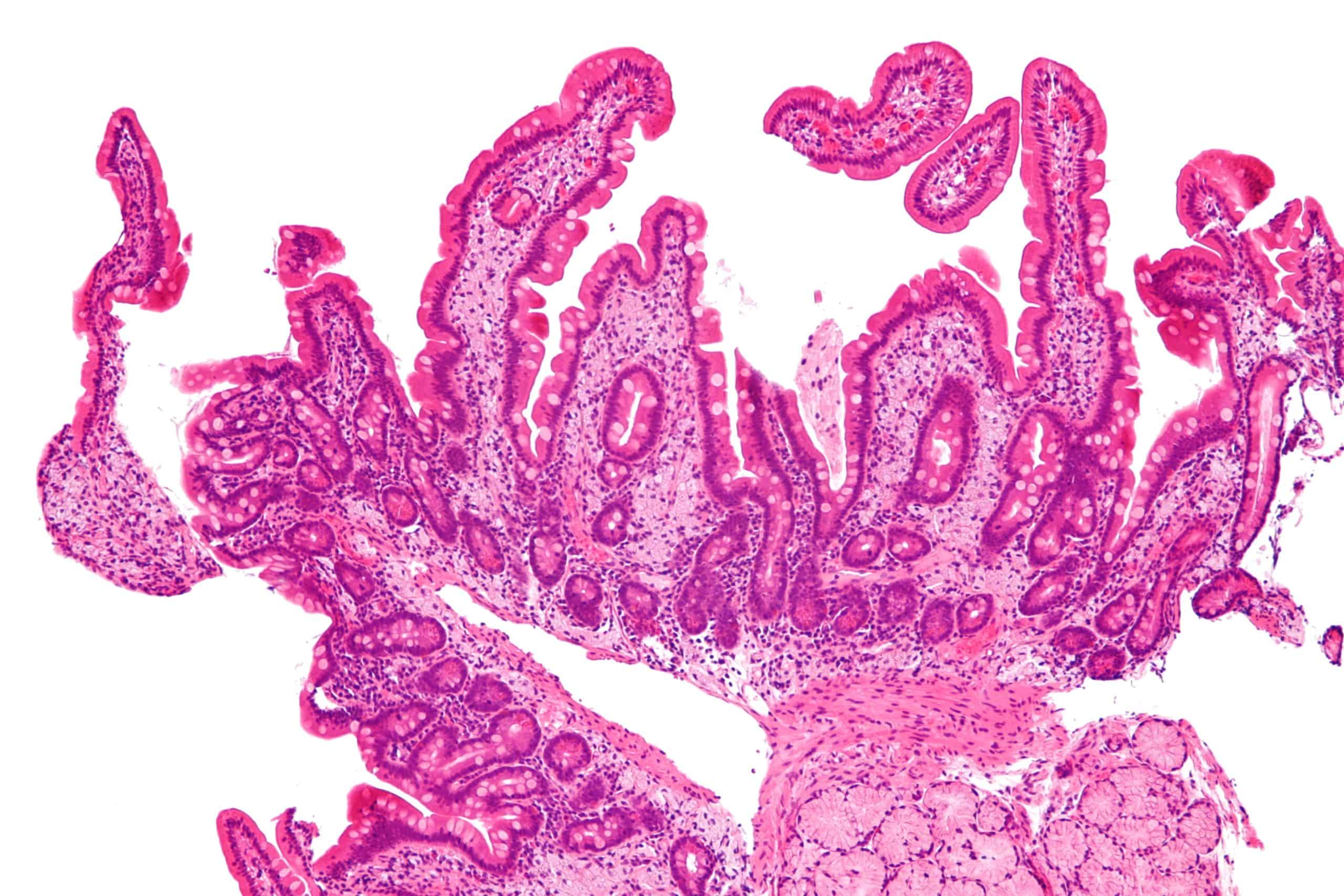 Whipple disease - Symptoms, Diagnosis and Treatment - Costamedic