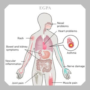 Read more about the article EGPA disease
