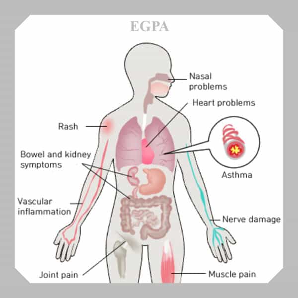 EGPA disease - Costamedic