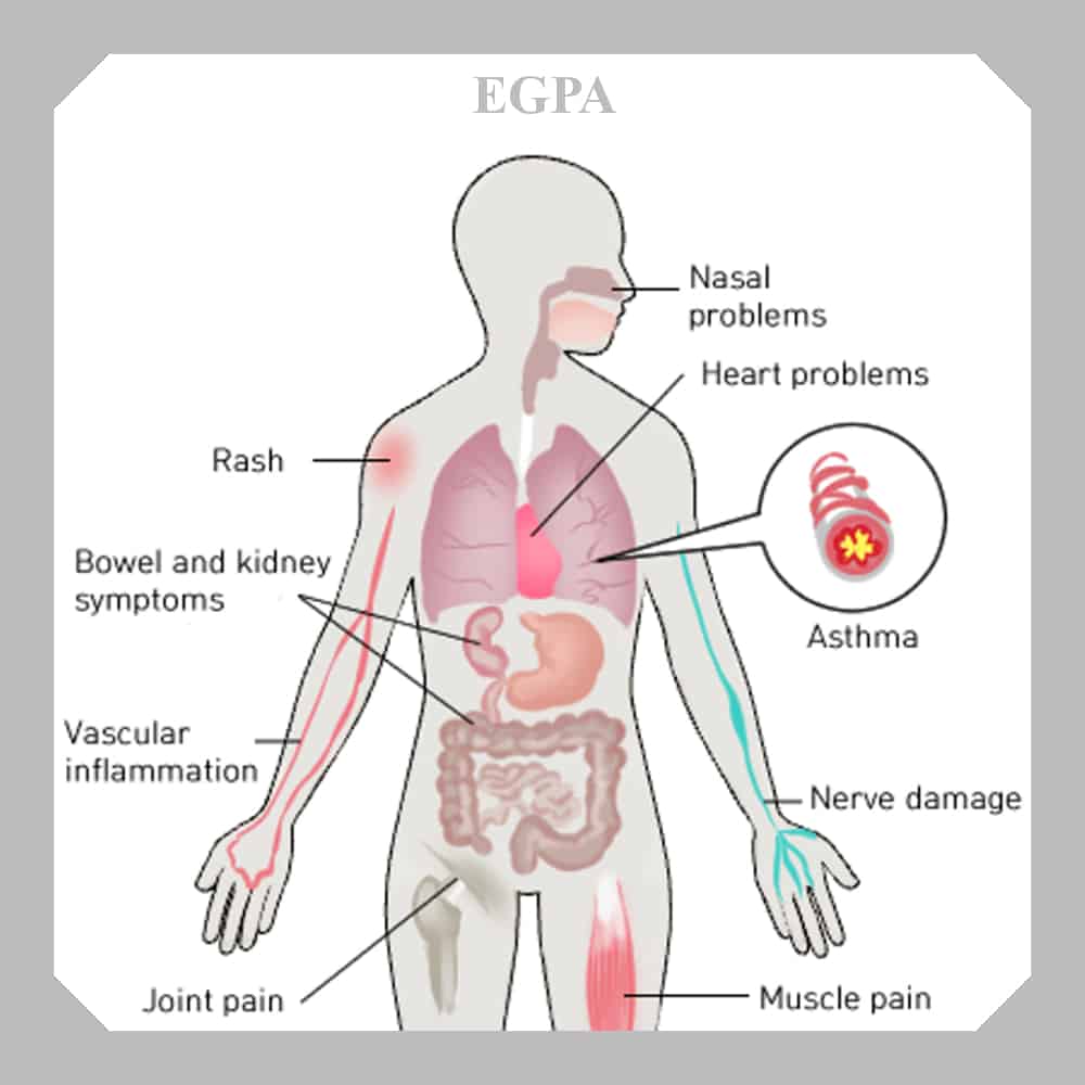 EGPA disease