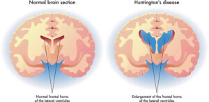 Read more about the article Huntington’s Disease (Learn in 5 minutes)