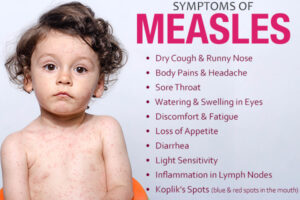 Read more about the article Measles Eradication – Why It’s Still Not Possible?