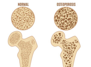 Read more about the article Osteoporosis – Symptoms, risk factors, fracture prevention, and pain control