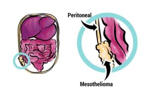 Read more about the article Peritoneal Mesothelioma – Essential Knowledge