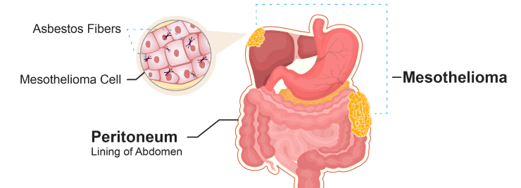 peritoneal mesothelioma