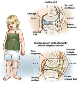 Read more about the article Systemic juvenile rheumatoid arthritis