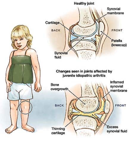systemic juvenile rheumatoid arthritis