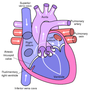 Read more about the article Tricuspid Atresia