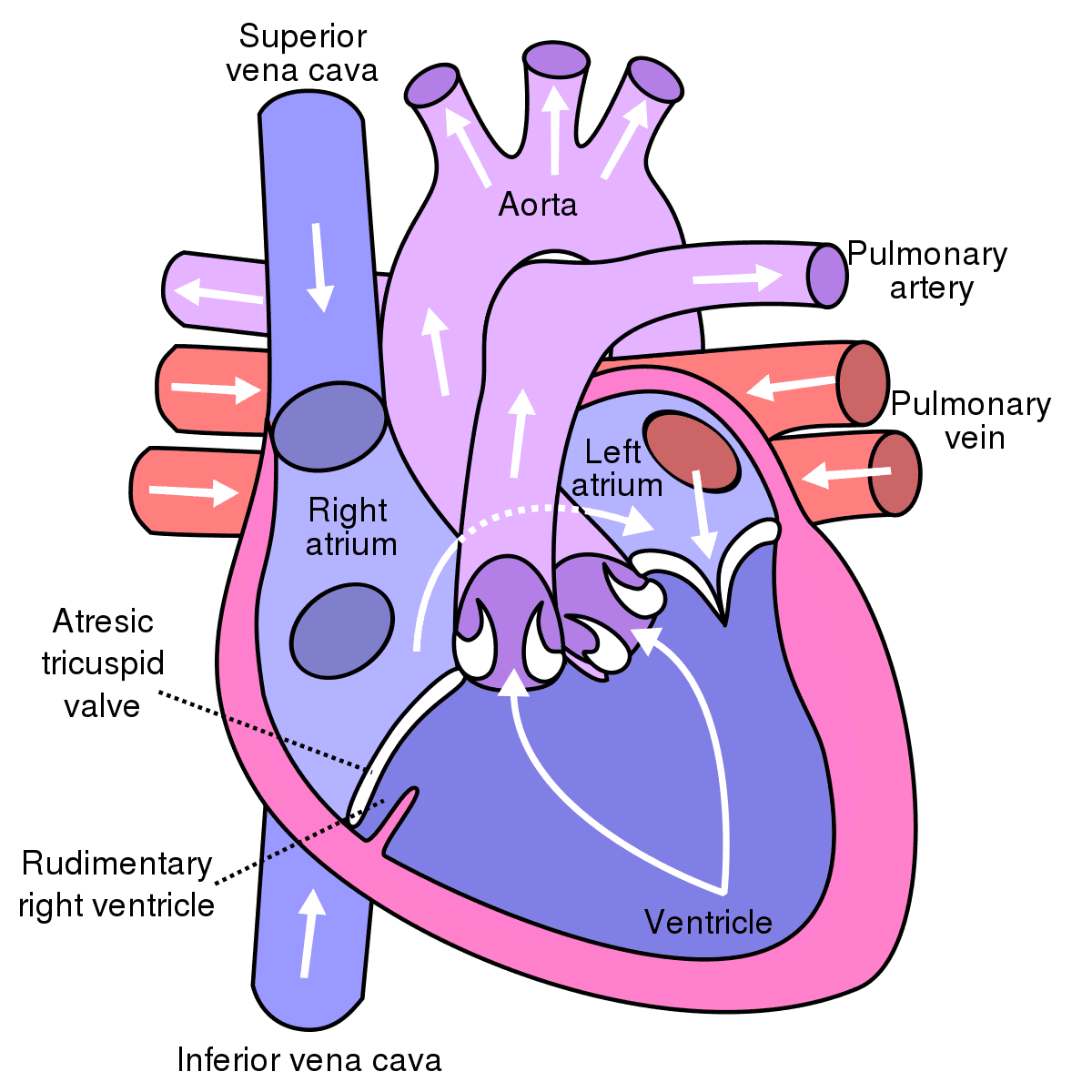 Tricuspid Atresia - Costamedic