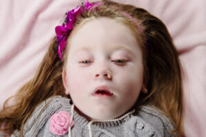 Read more about the article Krabbe Disease