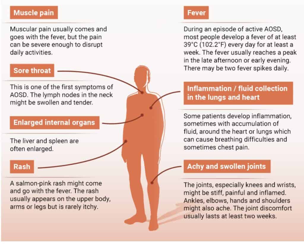 Stills Disease