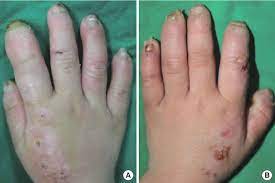 Read more about the article CIPA Disease