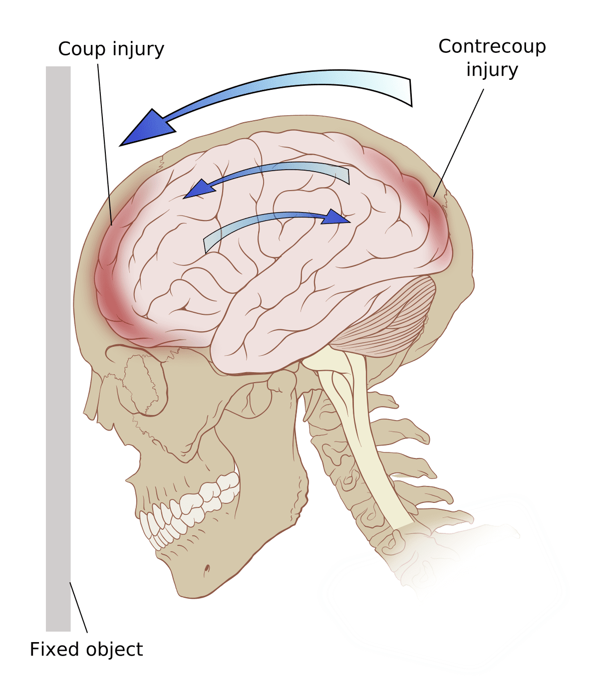 second-impact-syndrome-costamedic