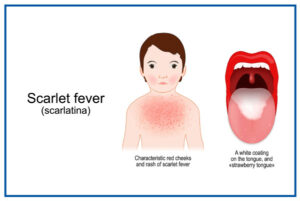 Scarlet fever symptoms