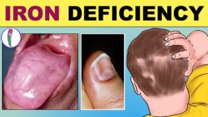 Read more about the article Do I have iron deficiency?