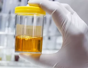 Read more about the article Proteinuria causes, diagnosis, and treatment